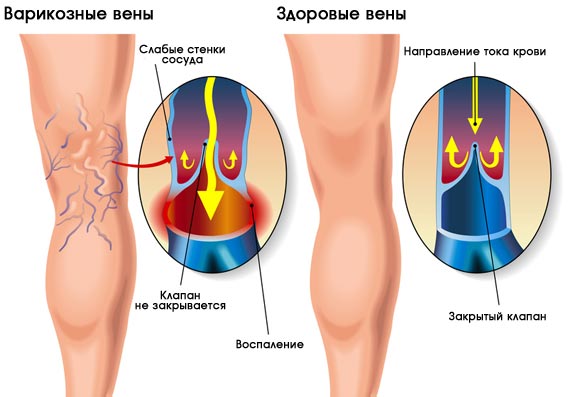 Лазерная терапия в лечении варикоза